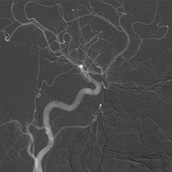 File:Normal cerebral angiogram (four vessel DSA) (Radiopaedia 41708-44649 I 8).png