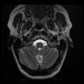 Normal cervical and thoracic spine MRI (Radiopaedia 35630-37156 Axial T2 34).png
