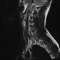 Normal cervical spine MRI (Radiopaedia 38418-40496 Sagittal T2 1).jpg