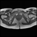 Normal female pelvis MRI (retroverted uterus) (Radiopaedia 61832-69933 Axial T1 25).jpg