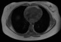 Normal liver MRI with Gadolinium (Radiopaedia 58913-66163 Axial T1 in-phase 33).jpg