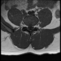 Normal lumbar spine MRI (Radiopaedia 35543-37039 Axial T1 14).png