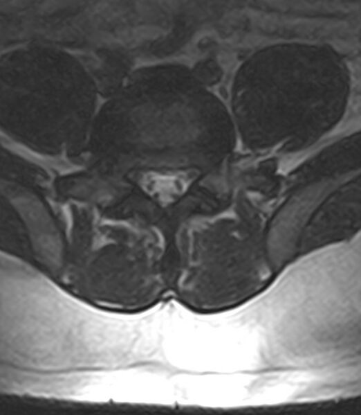 File:Normal lumbar spine MRI - low-field MRI scanner (Radiopaedia 40976-43699 Axial T2 78).jpg