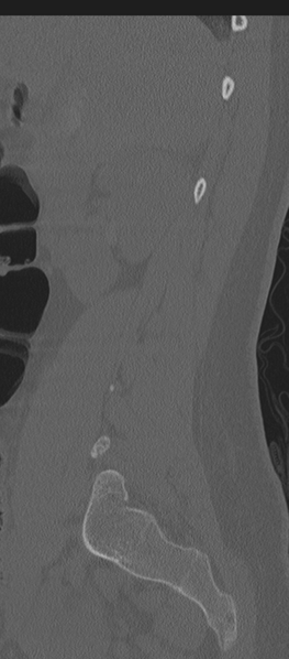 File:Normal lumbosacral CT (Radiopaedia 37923-39867 Sagittal bone window 77).png