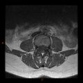 Normal spine MRI (Radiopaedia 77323-89408 Axial T1 9).jpg