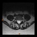 Normal spine MRI (Radiopaedia 77323-89408 Axial T2 20).jpg