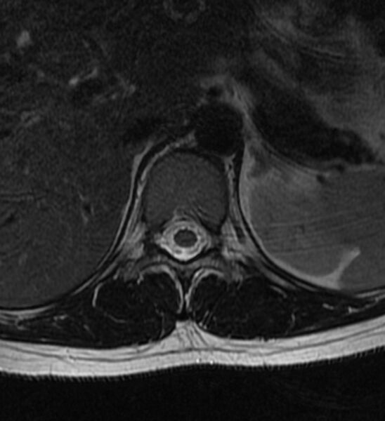 File:Normal thoracic spine MRI (Radiopaedia 41033-43781 Axial T2 23).jpg