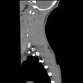 Normal trauma spine imaging (age 16) (Radiopaedia 45335-49358 C 35).jpg
