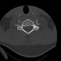 Occipital condyle fracture (Radiopaedia 31755-32691 Axial bone window 57).jpg