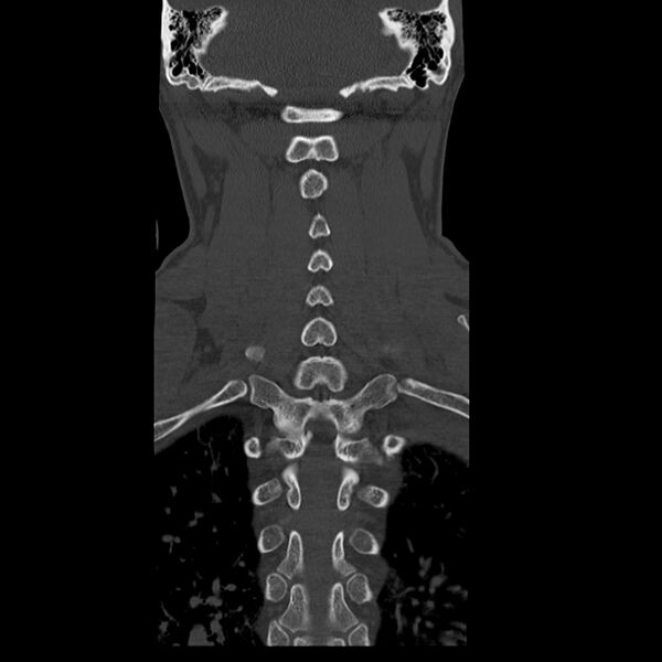 File:Occipital condyle fracture (Radiopaedia 31755-32691 Coronal bone window 24).jpg