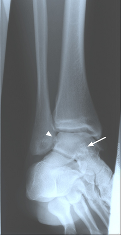 Oblique ankle radiograph with evidence of calcified loose bodies medial arrow head to the lateral maleolus and superimposed over the talus arrow, this suggests synovial chondromatosis