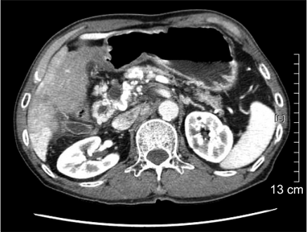 Computed tomography scan showing portal vein thrombosis (with cavernous change of portal vein )