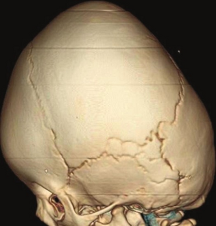 Volume-rendered image showing evidence of turricephaly