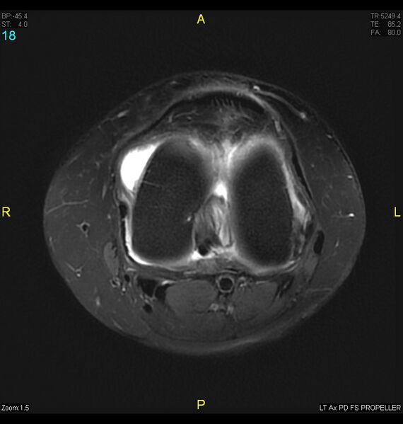 File:ACL mucoid degeration with cystic changes (Radiopaedia 48428-53341 Axial PD fat sat 15).jpg