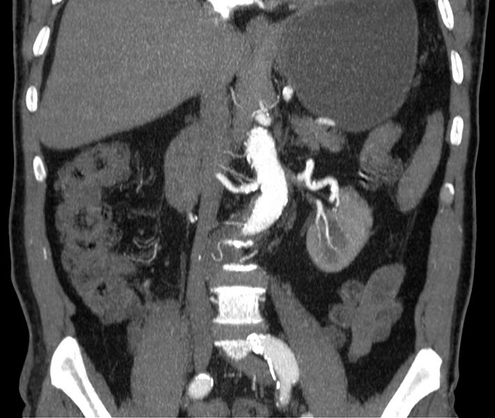 File:Abdominal aortic aneurysm (Radiopaedia 22421-22458 C 22).jpg