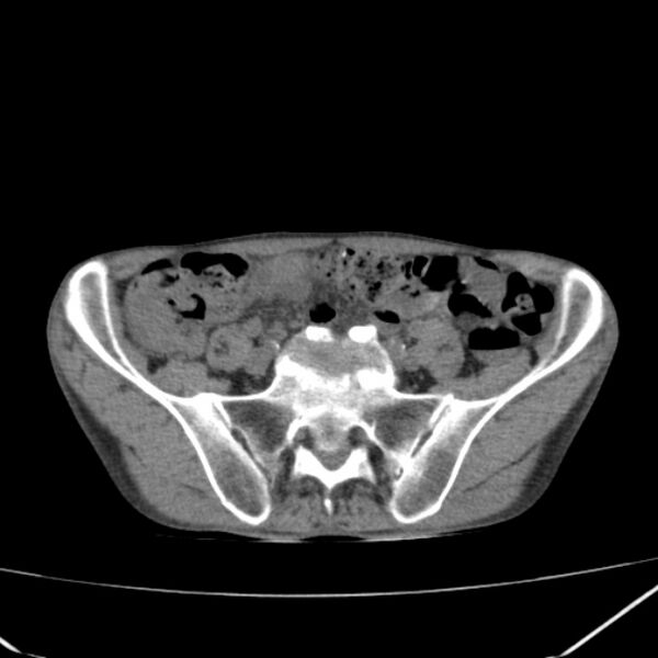File:Abdominal aortic aneurysm (Radiopaedia 23703-23856 Axial non-contrast 42).jpg