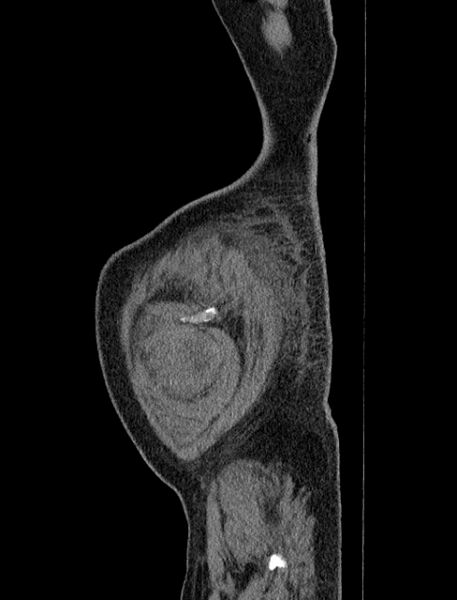 File:Abdominal aortic aneurysm rupture (Radiopaedia 54179-60362 Sagittal C+ arterial phase 46).jpg