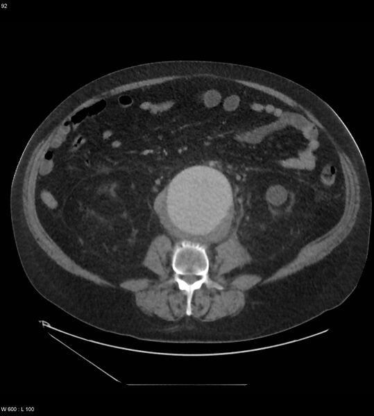 File:Abdominal aortic aneurysm with intramural hematoma then rupture (Radiopaedia 50278-55631 Axial C+ arterial phase 83).jpg