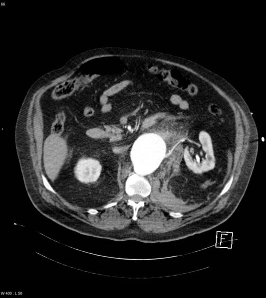 File:Abdominal aortic aneurysm with intramural hematoma then rupture (Radiopaedia 50278-55632 Axial C+ arterial phase 65).jpg