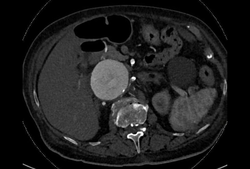 File:Abdominal aortic aneurysm with thrombus fissuration (Radiopaedia 73192-83919 Axial C+ arterial phase 46).jpg