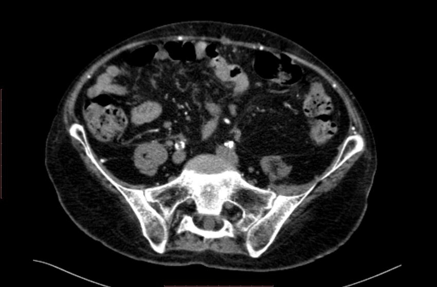 Abdominal aortic interposition tube graft and aneurysm thrombosis (Radiopaedia 71438-81857 Axial C+ arterial phase 147).jpg