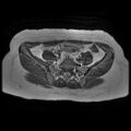 Abdominal wall endometriosis (Radiopaedia 83702-98847 Axial T1 2).jpg