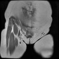Abdominal wall endometriosis (Radiopaedia 83702-98847 Coronal T1 1).jpg