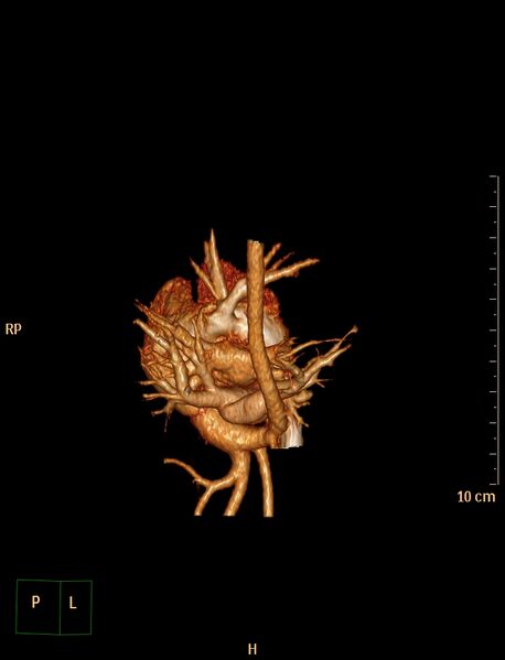 File:Aberrant left pulmonary artery (pulmonary sling) (Radiopaedia 42323-45435 3D reconstruction C+ CTPA 18).jpg