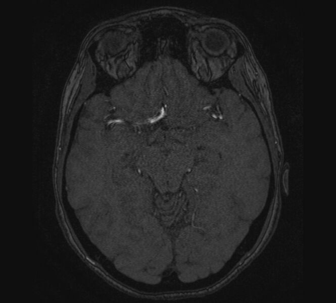 File:Accessory middle cerebral artery and ICA aneurysm (Radiopaedia 22656-22674 MRA 55).jpg