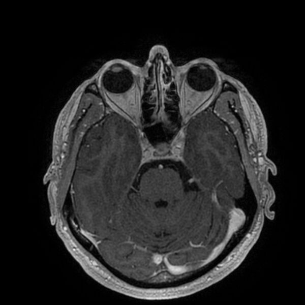 File:Acoustic schwannoma - intracanalicular (Radiopaedia 37247-39024 Axial T1 C+ 86).jpg