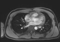 Active right ventricular cardiac sarcoidosis (Radiopaedia 55596-62100 Axial Post contrast Dixon 42).jpg