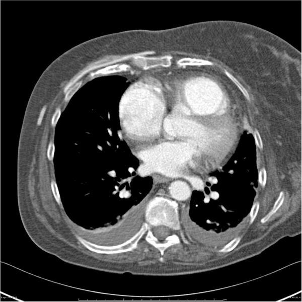 File:Acute-on-chronic pulmonary emboli (Radiopaedia 27925-28169 C+ CTPA 48).jpg
