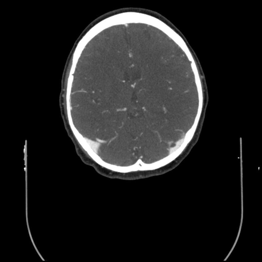 Acute M1 occlusion with ischemic penumbra (CT perfusion) (Radiopaedia 71897-82344 Axial C+ arterial phase thins 47).jpg