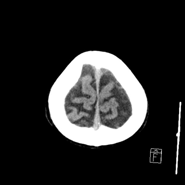 File:Acute P1 occlusion with PCA ischemia penumbra (CT perfusion) (Radiopaedia 72084-82586 Axial non-contrast 43).jpg