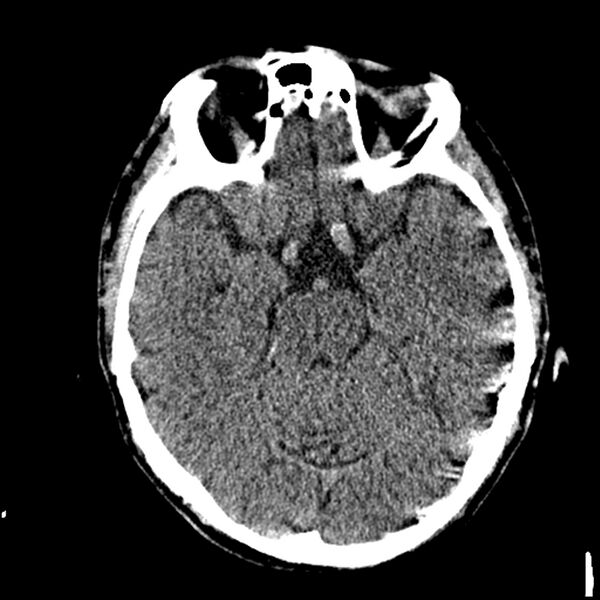 File:Acute P1 occlusion with PCA ischemia penumbra (CT perfusion) (Radiopaedia 72084-82586 Axial non-contrast thins 5).jpg