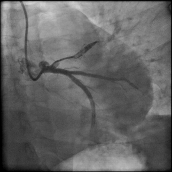 File:Acute anteroseptal myocardial infarction (Radiopaedia 68409-77946 LAO caudal (spider view) LAD and CX 17).jpg