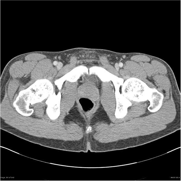 File:Acute appendicitis (Radiopaedia 25364-25615 B 73).jpg