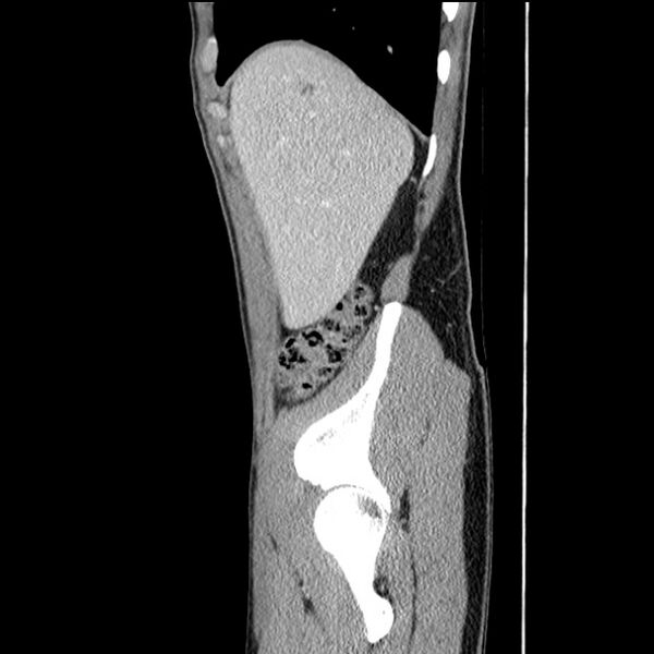 File:Acute appendicitis (Radiopaedia 27049-27227 Sagittal C+ portal venous phase 13).jpg
