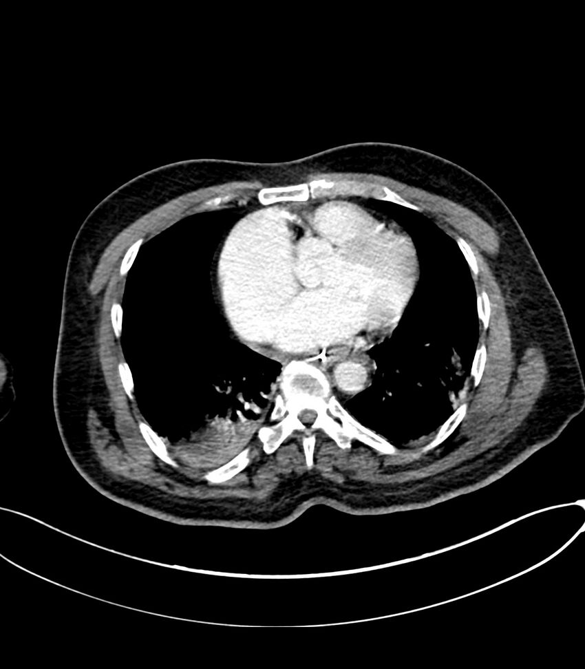 Acute arterial mesenteric ischemia (Radiopaedia 78238-90828 Axial C+ portal venous phase 9).jpg