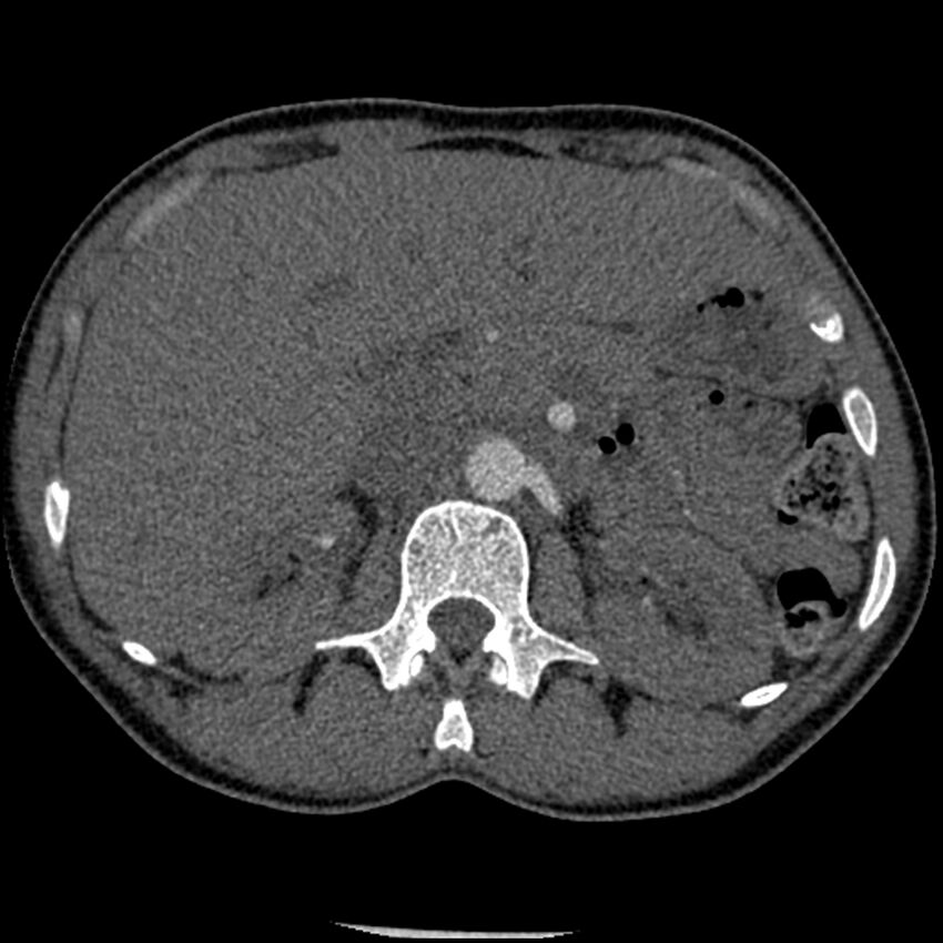 Acute chest syndrome - sickle cell disease (Radiopaedia 42375-45499 Axial C+ CTPA 230).jpg