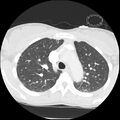 Acute chest syndrome - sickle cell disease (Radiopaedia 42375-45499 Axial lung window 59).jpg