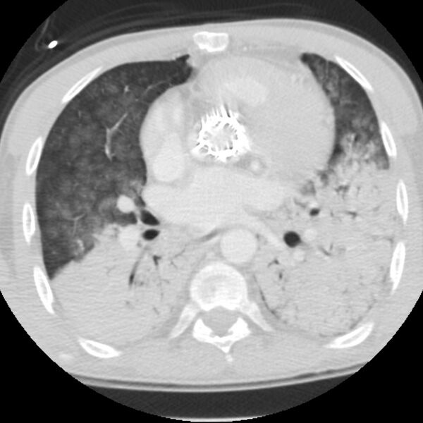 File:Acute diffuse alveolar hemorrhage (Radiopaedia 41323-44158 Axial lung window 33).jpg