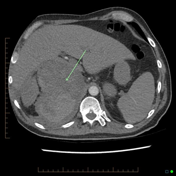File:Acute hemorrhage into adrenal metastasis from NSCLC (Radiopaedia 43135-46429 Axial C+ CTPA 12).jpg