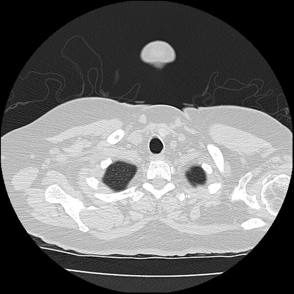 File:Acute interstitial pneumonitis (Radiopaedia 45404-49452 Axial lung window 5).jpg