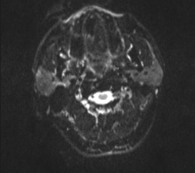 File:Acute ischemic stroke - posterior circulation territory (Radiopaedia 77670-89880 Axial DWI 1).jpg