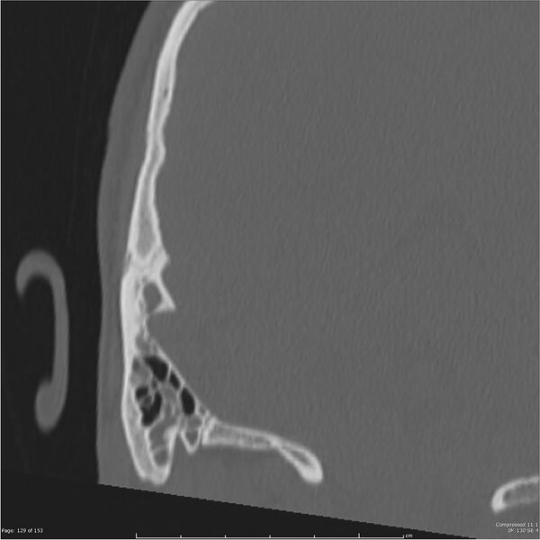 File:Acute otomastoiditis (Radiopaedia 28276-28512 Coronal PTB bone window reformat 60).jpg