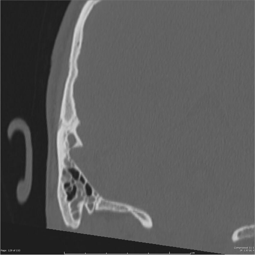 Acute otomastoiditis (Radiopaedia 28276-28512 Coronal PTB bone window reformat 60).jpg