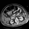 Acute pancreatic necrosis (Radiopaedia 13560-18502 Axial C+ portal venous phase 39).jpg