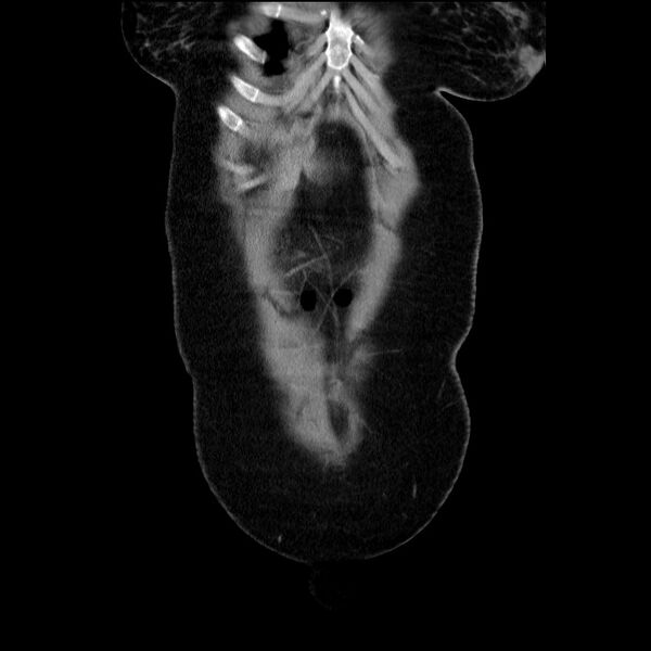 File:Acute pancreatitis (Radiopaedia 69236-79012 Coronal C+ portal venous phase 63).jpg