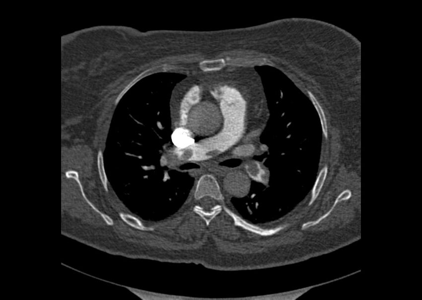 Acute pulmonary embolism (Radiopaedia 29938-30466 Axial C+ CTPA 57).jpg